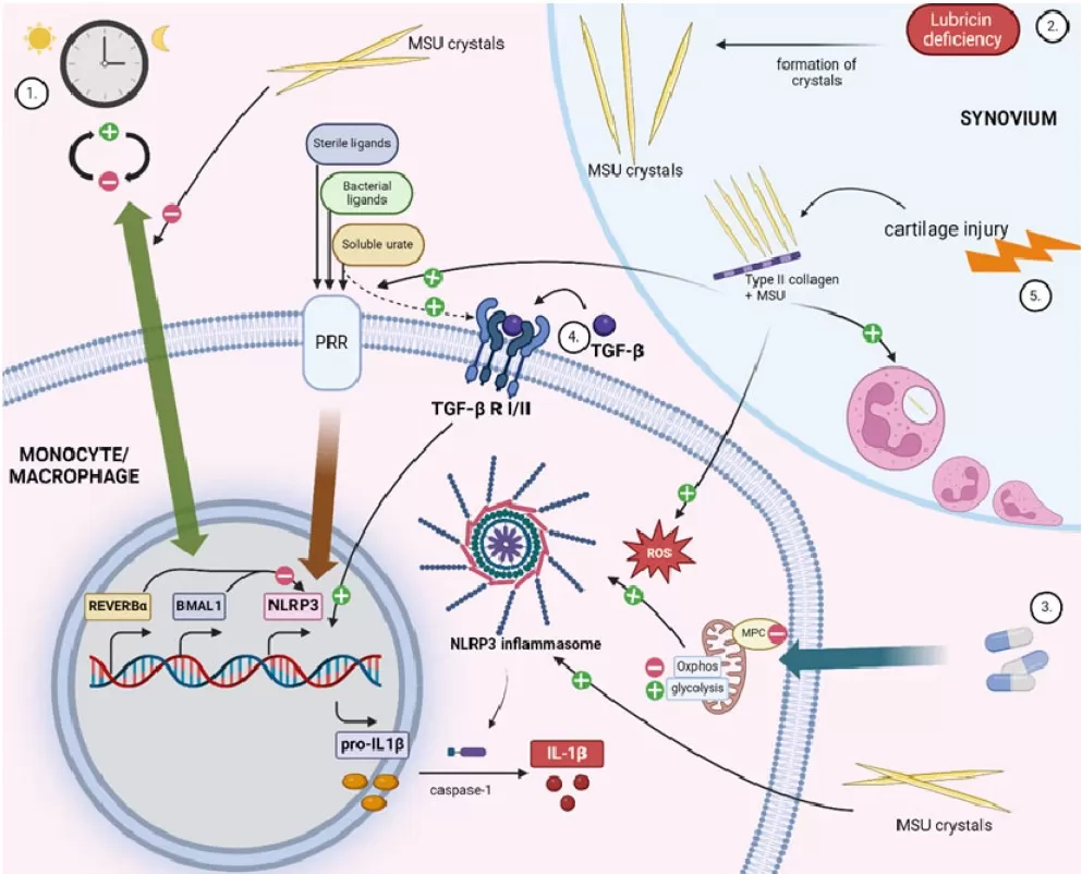 Highlights of inflammatory mechanisms in gout showing MSU crystal activation of NLRP3 inflammasome and IL-1beta signaling pathways