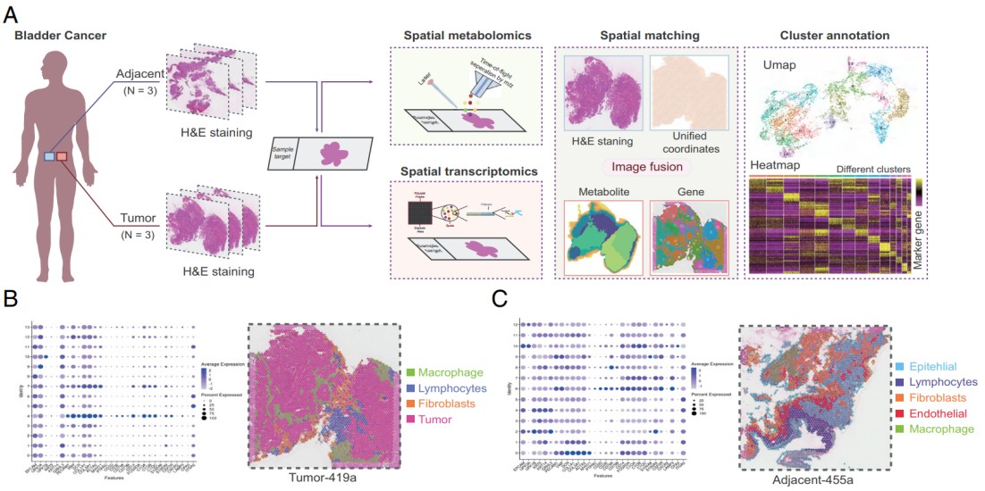 Spatial multiomics case study revealing bladder cancer heterogeneity and immunometabolic reprogramming