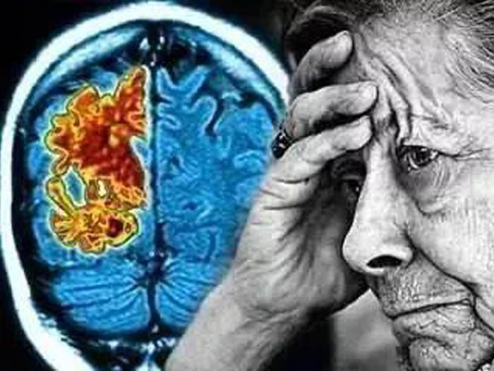 Alzheimer's-Disease
