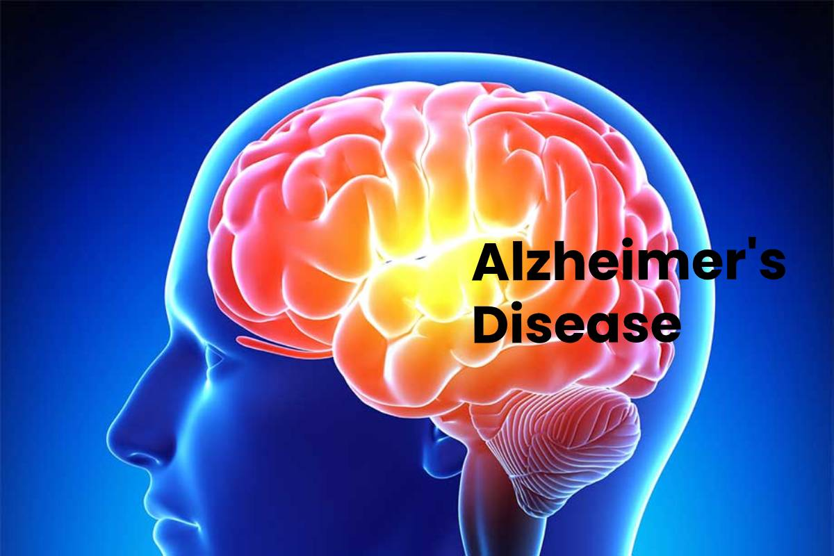 Metabolomics_in_Alzheimer's_Disease